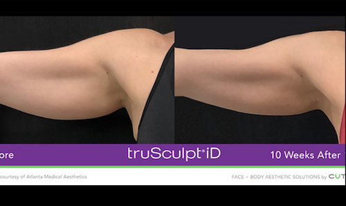 fat loss arm contouring before after mississauga oakville